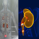 سنگ کلیه چیست؟ آنچه لازم است بدانید.